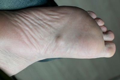 Understanding a Plantar Fibroma